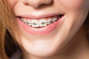 Metal Braces