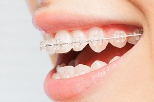 Ceramic Braces