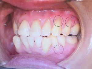 Tooth-Coloured Fillings