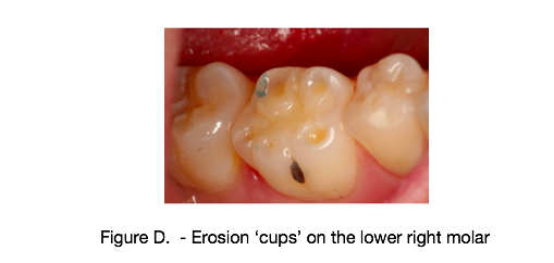 Lemon Water An Abundance of Health Benefits but is it Good for our Teeth dePacific Dental Group