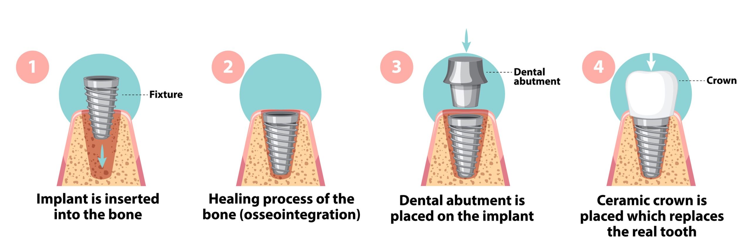Dental Implant Fixture