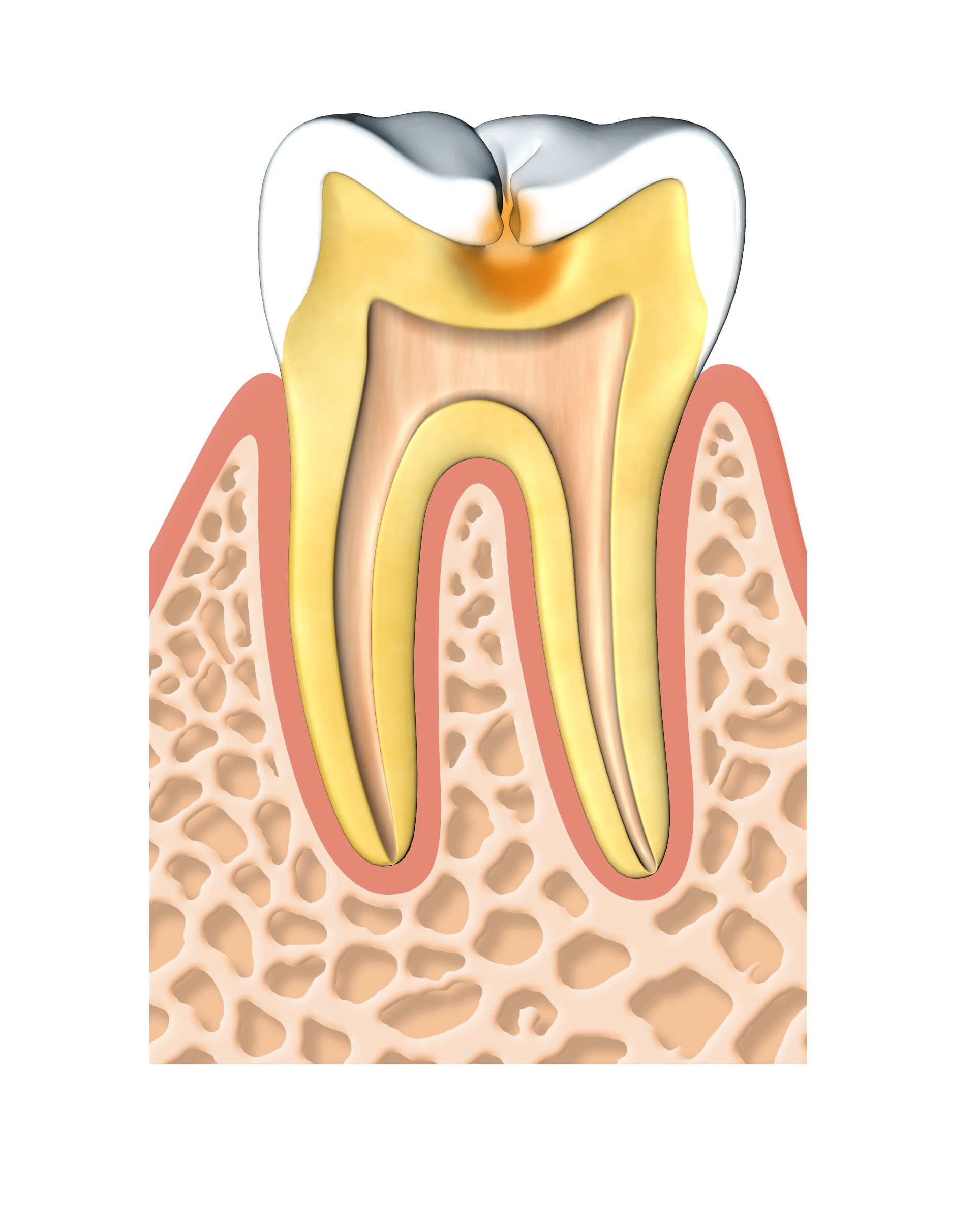 Root Canal Treatment in Singapore, Root Canal Treatment Cost Singapore