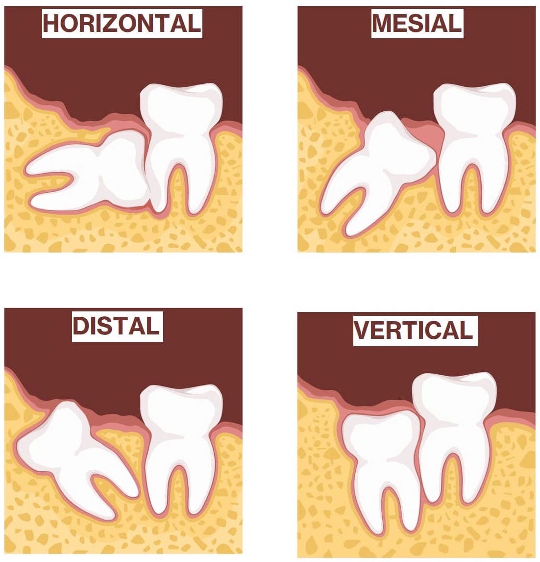 Types of Wisdom Tooth Impaction That Require Wisdom Teeth Removal