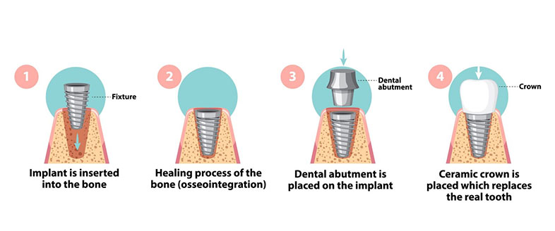 Dental Implant Surgery Step By Step Procedure