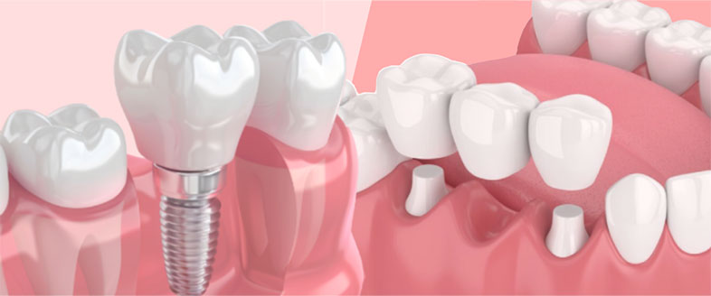 Dental Implant and Dental Bridge Side By Side Illustration