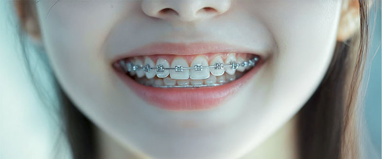 Can Braces Affect Smile