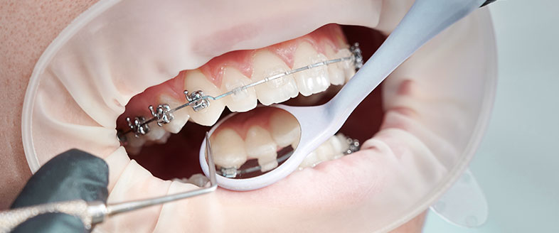 Dentist Applying Braces