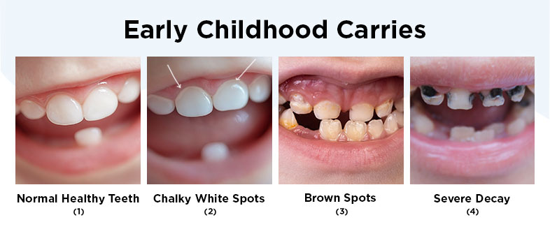 Signs of Tooth Decay, Early Childhood Carries