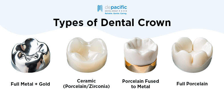 Types of Dental Crown