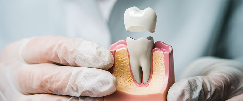 Dental Crowns, What Are Crowned Teeth