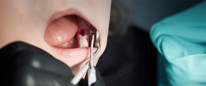 When is a tooth filling needed?