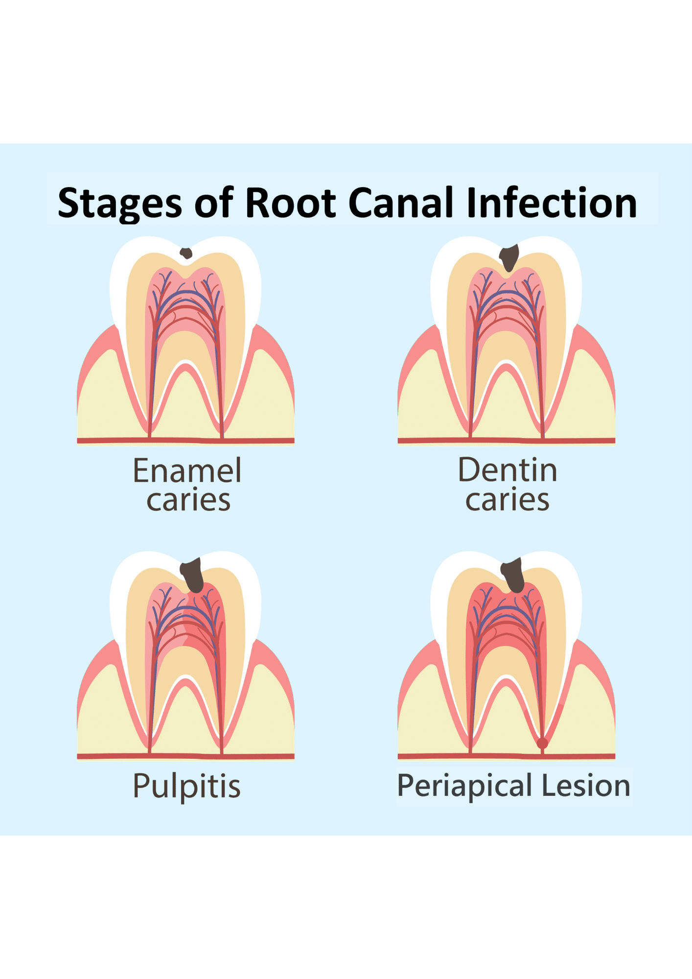 Infected Tooth